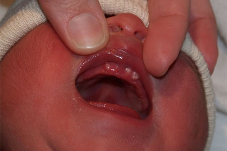 13 сыпей новорожденных и младенцев: что норма, а что нет