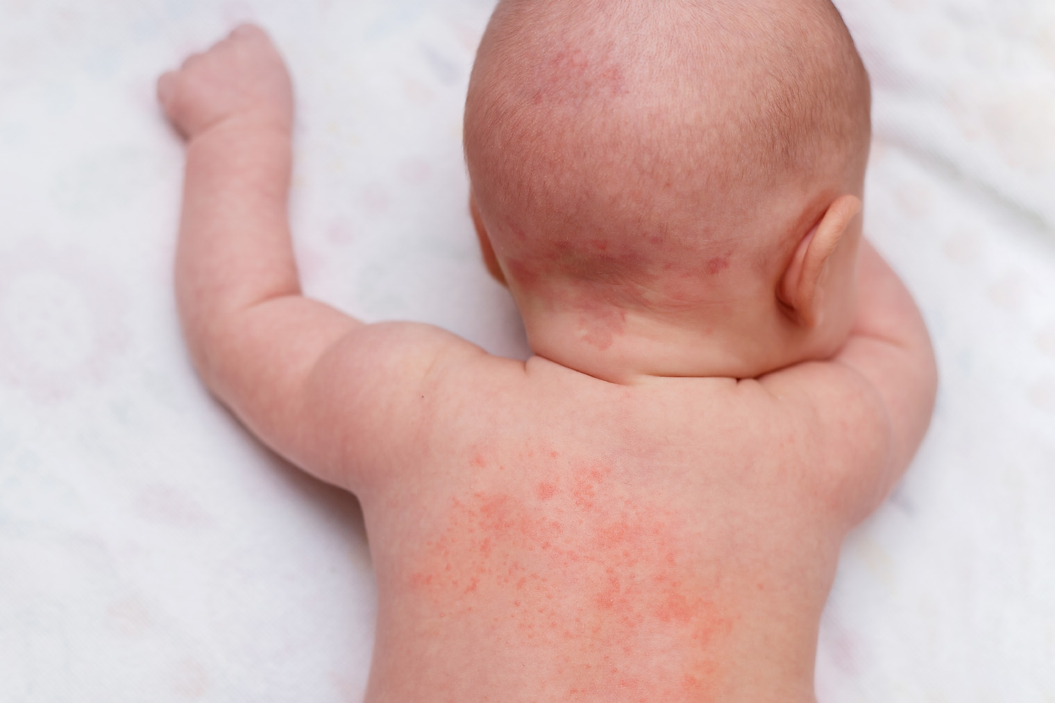 Аллергическая сыпь у детей