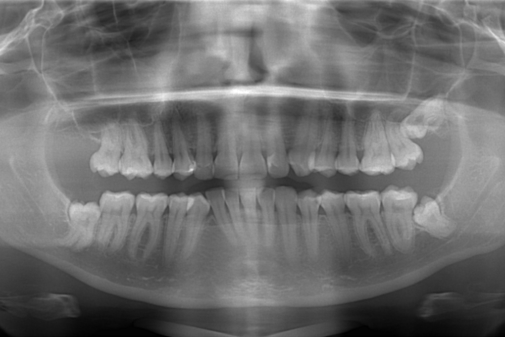 Почему опухает щека после удаления зуба – стоматология ПрезиДЕНТ