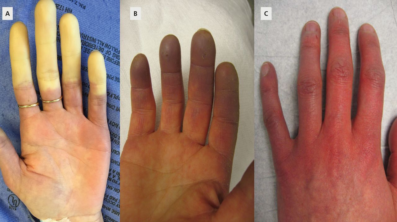 Синдром Рейно: побеление пальцев из⁠-⁠за сужения сосудов, синий цвет из⁠-⁠за застоя венозной крови и покраснение. Источник: ccjm.org
