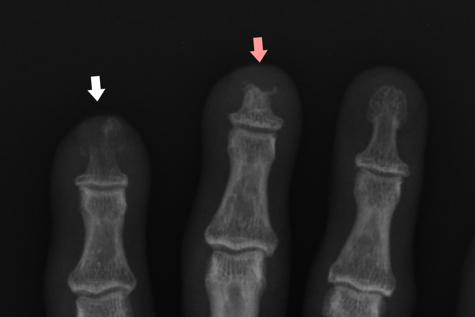 Так будет выглядеть разрушение концевых фаланг пальцев на рентгене при склеродермии. Источник: roentgenrayreader.blogspot.com