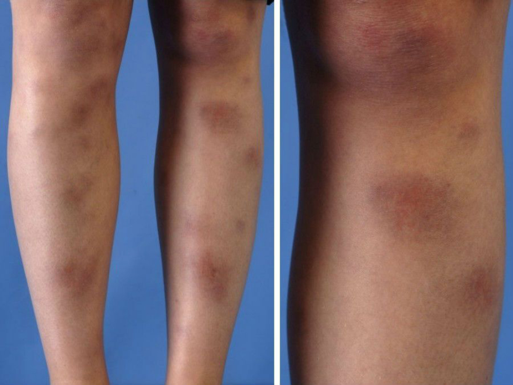 Узловатая эритема на ногах. Источник: pcds.org
