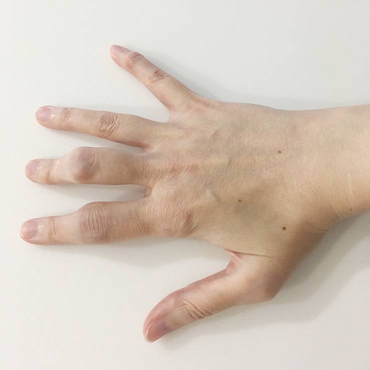 Артрит пальцев рук мази лечение- СЕКРЕТНЫЕ МЕТОДИКИ- ⭐ Виктория Степаненко