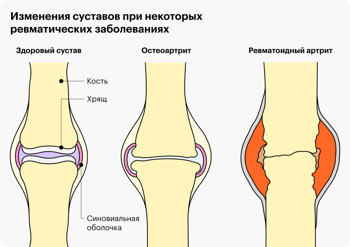 Вопросы ревматологу: что за врач и что лечит, когда обращаться и как найти  хорошего