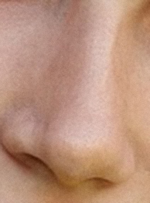 Вот так выглядел мой нос до операции и после. Внешнее искривление тоже исчезло