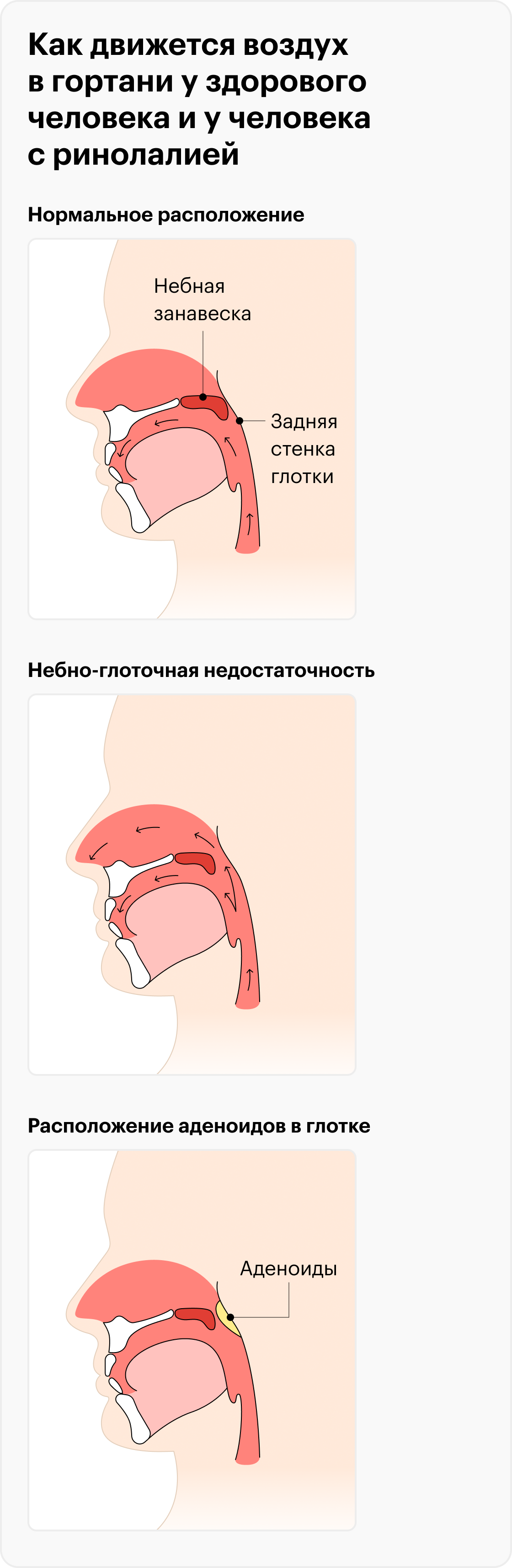Чтобы произнести большинство звуков речи, воздух и звук нужно направить в рот и перекрыть от попадания в полость носа. Это делает нёбно-глоточной клапан. На рисунке слева показано, как у здорового человека поднимается нёбная занавеска, чтобы сомкнуться с задней стенкой глотки. В центре показана нёбно-глоточная недостаточность, характерная для расщелин нёба. Справа — расположение аденоидов в глотке