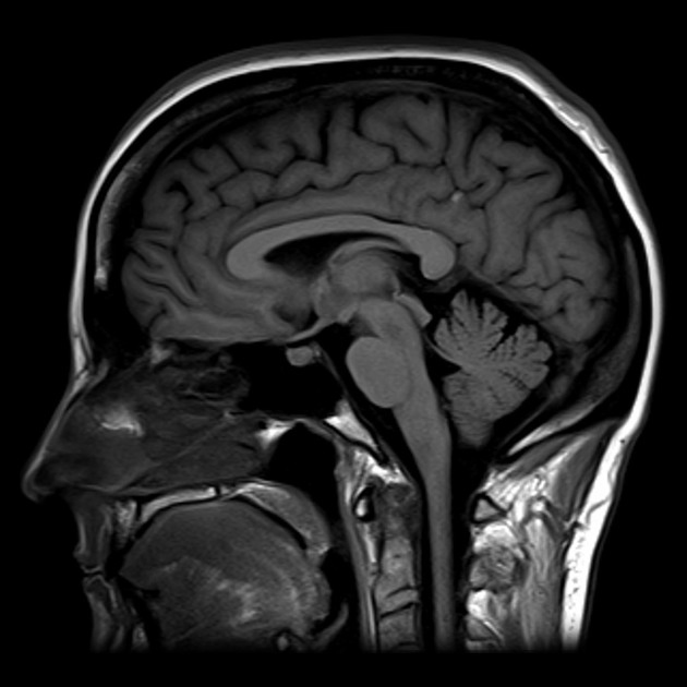 МРТ позволяет получить детальное изображение мягких тканей, она хорошо подходит для обследования головного и спинного мозга, внутренних органов, суставов, связок и сухожилий. Источник: radiopaedia.org