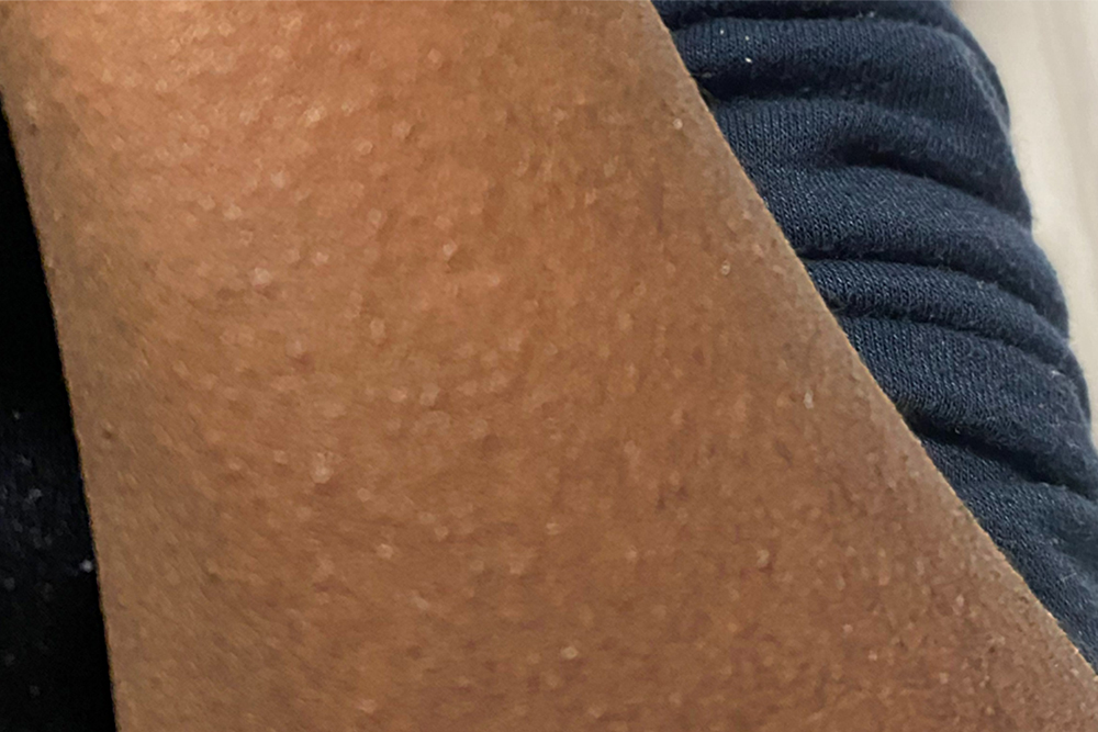 Сыпь при скарлатине у людей с темным цветом кожи. Источник: NHS