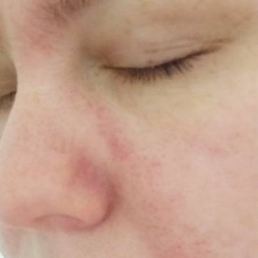 Лечение дерматита на лице