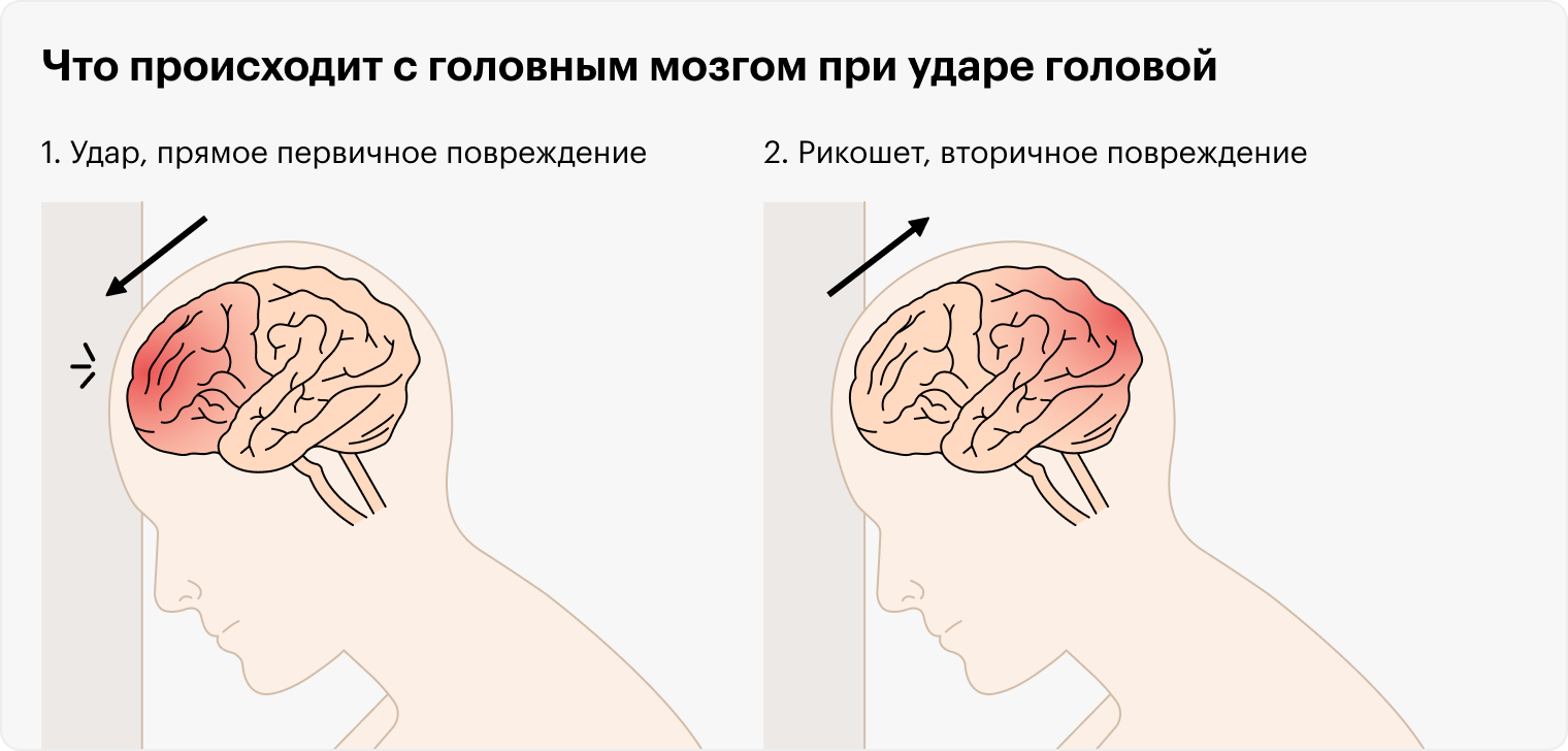 Когда человек ударяется головой, мозг раскачивается во внутричерепной жидкости и ударяется о стенки черепа