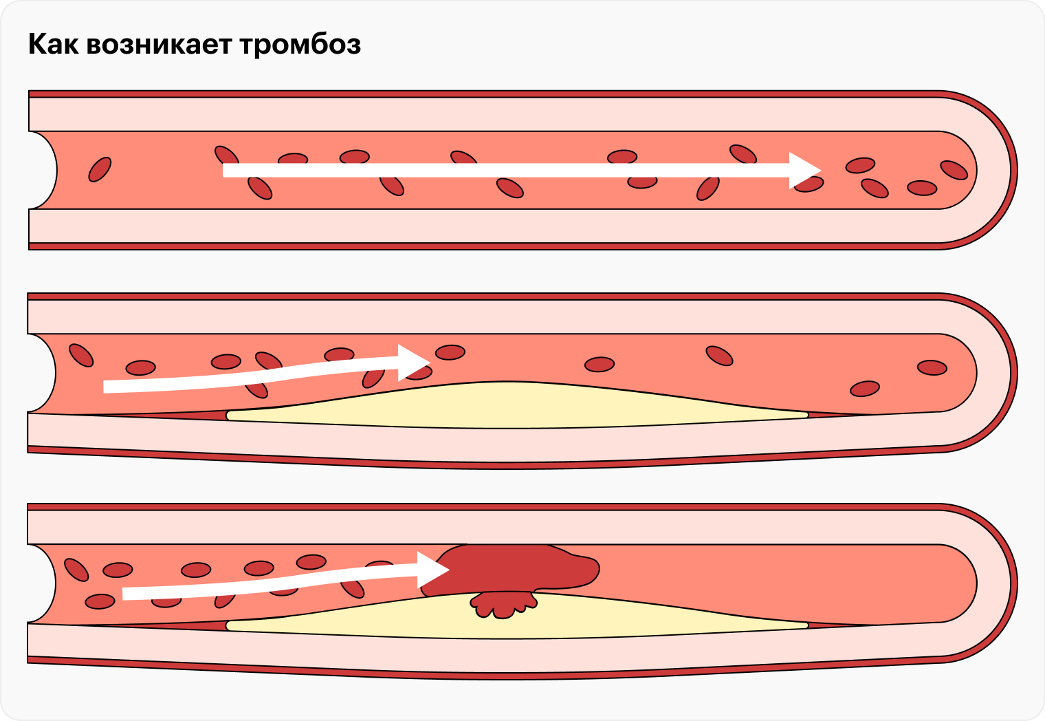 Атеросклеротические бляшки могут разрушаться, тогда содержимое попадает в кровь, что приводит к тромбозу