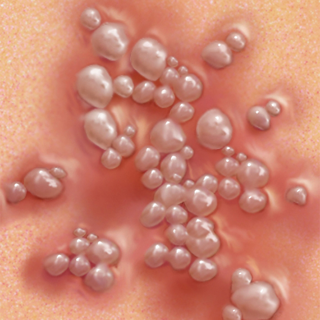 Волдыри при генитальном герпесе. Источник: healthdirect.gov.au