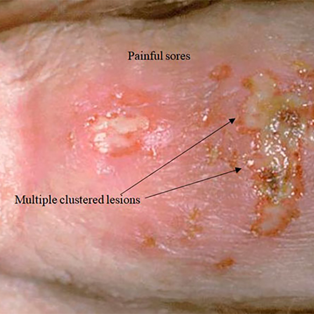 Язвы при генитальном герпесе. Источник: stdcenterny.com