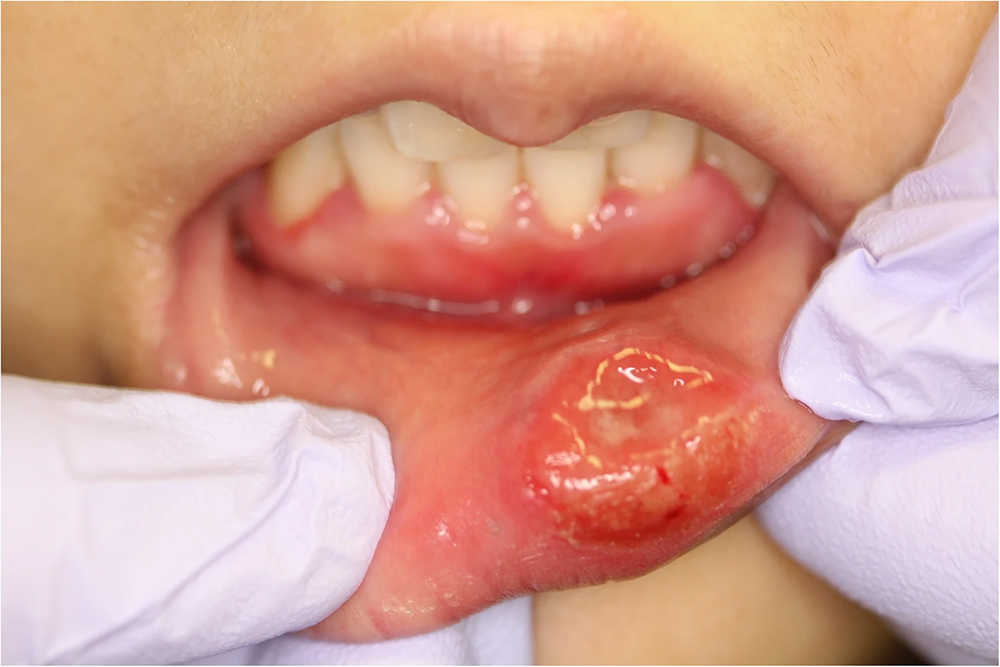 Твердый шанкр на губе у женщины с первичным сифилисом. Источник: jmedicalcasereports.biomedcentral.com