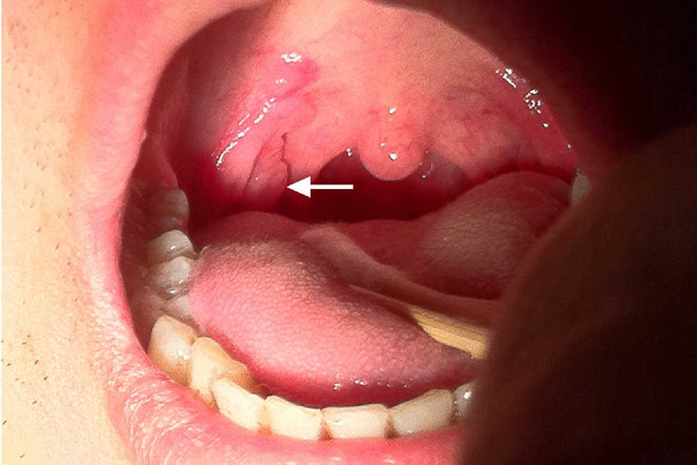Широкие кондиломы во рту при вторичном сифилисе. Источник: ars.els-cdn.com