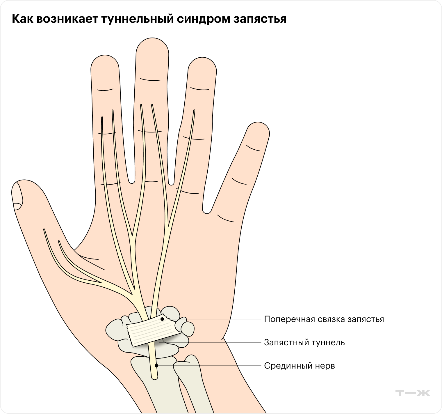 Карпальный синдром возникает из-за сдавливания срединного нерва в запястном канале. Срединный нерв обеспечивает чувствительность кожи большого, указательного, среднего пальцев, а также половины безымянного пальца