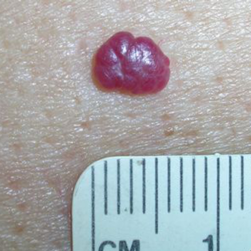 Доброкачественная гемангиома. Источник: cancer.org