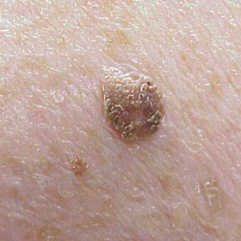 Себорейный кератоз. Некрасивое, но доброкачественное образование. Источник: rxlist.com