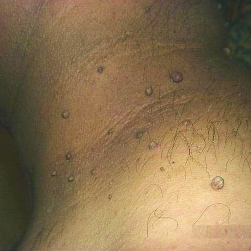 Мягкие фибромы. Похожи на бородавки, но не они. Источник: msdmanuals.com