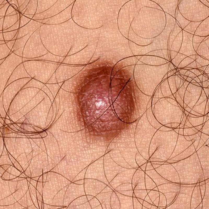 Дерматофиброма. Еще одна доброкачественная опухоль кожи. Источник: rxlist.com