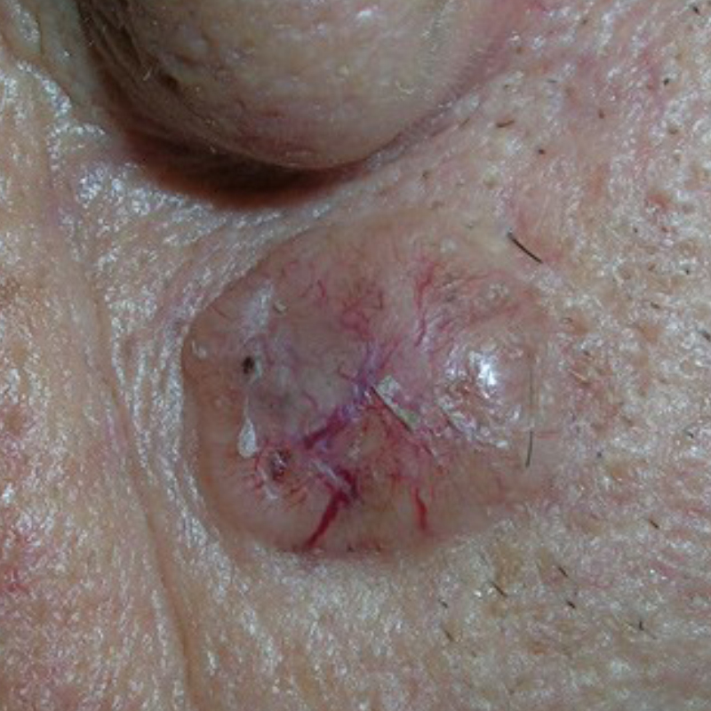 Нодулярная, или узелковая, базалиома. Источник: cancer.org
