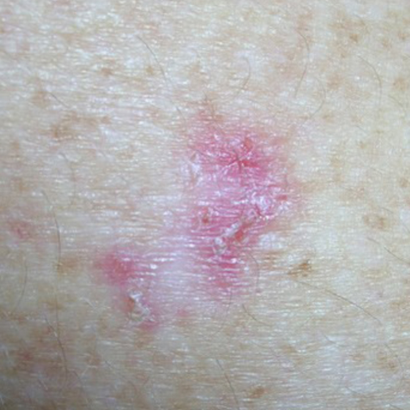 Поверхностная базалиома. Источник: cancer.org