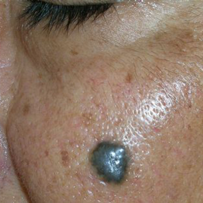 Пигментная базалиома. Источник: cancer.org
