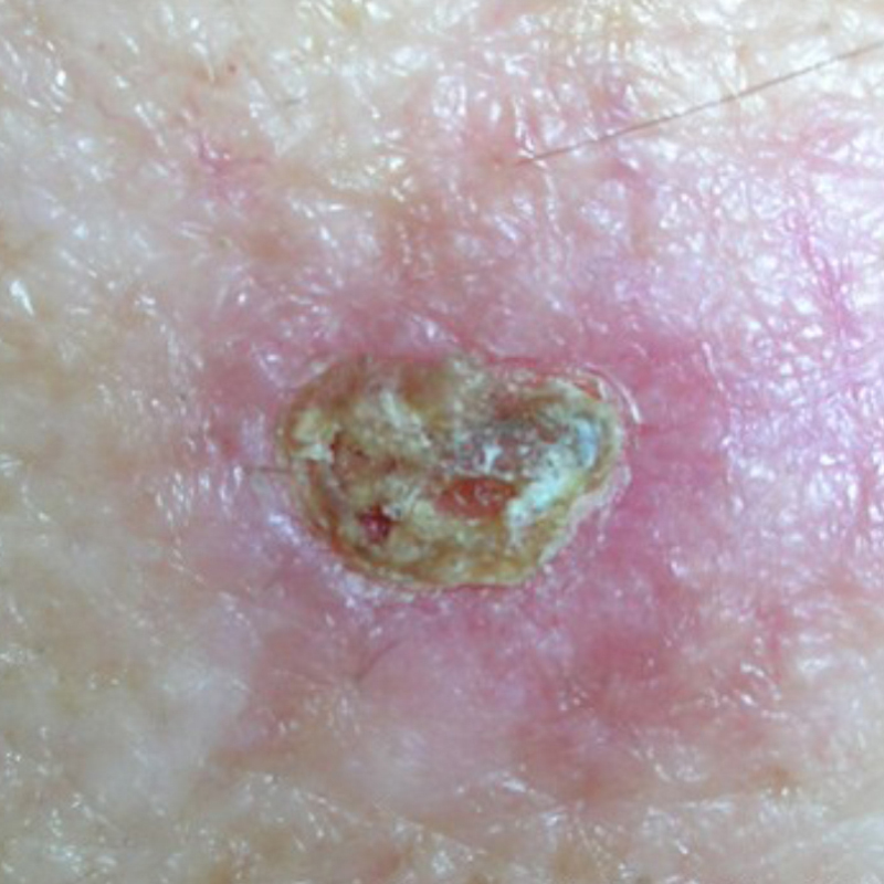 Базалиома, язвенная форма. Источник: cancer.org