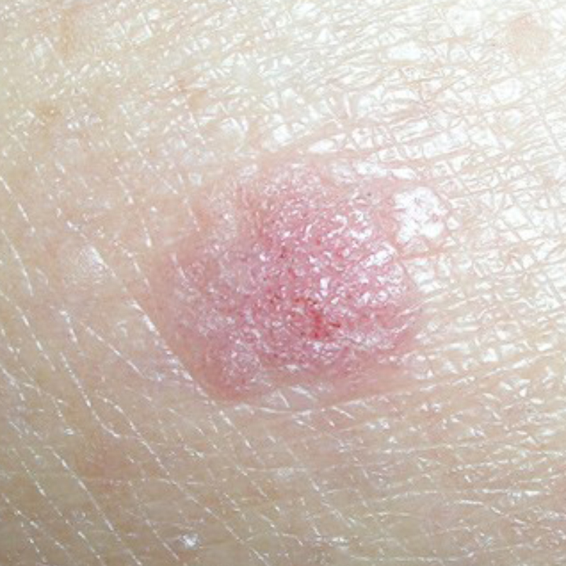 Плоскоклеточный рак. Источник: cancer.org