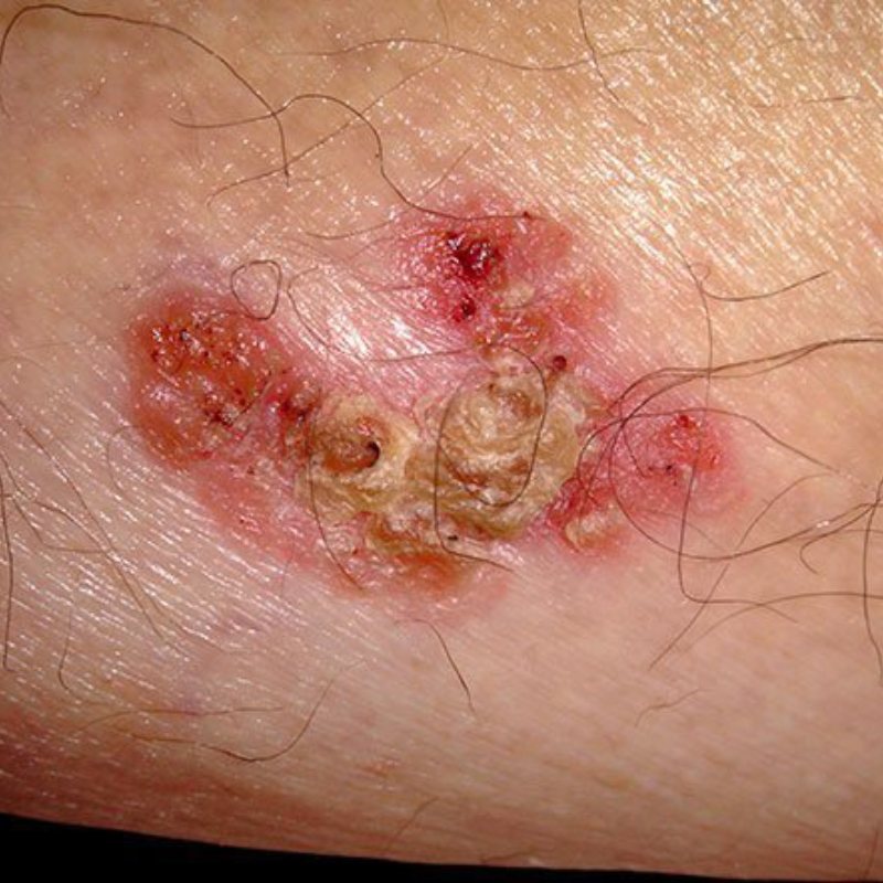 Еще один плоскоклеточный рак. Источник: rxlist.com