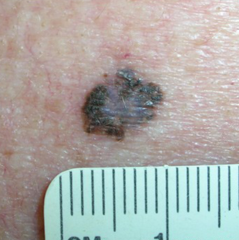 Поверхностно-распространяющаяся меланома. Источник: cancer.org