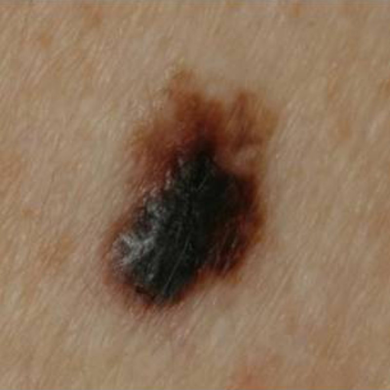 Узелковая меланома. Источник: msdmanuals.com