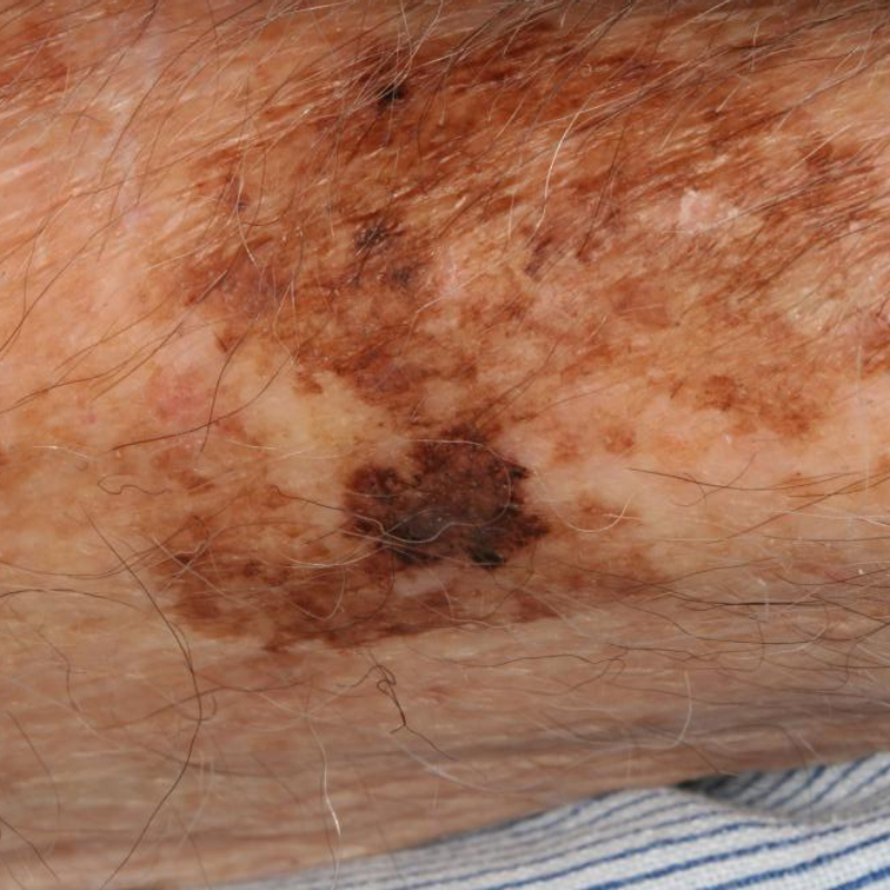 Лентиго-меланома. Источник: msdmanuals.com