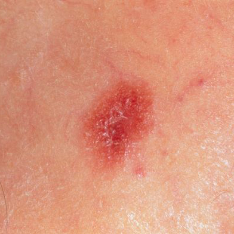 Беспигментная меланома. Источник: msdmanuals.com