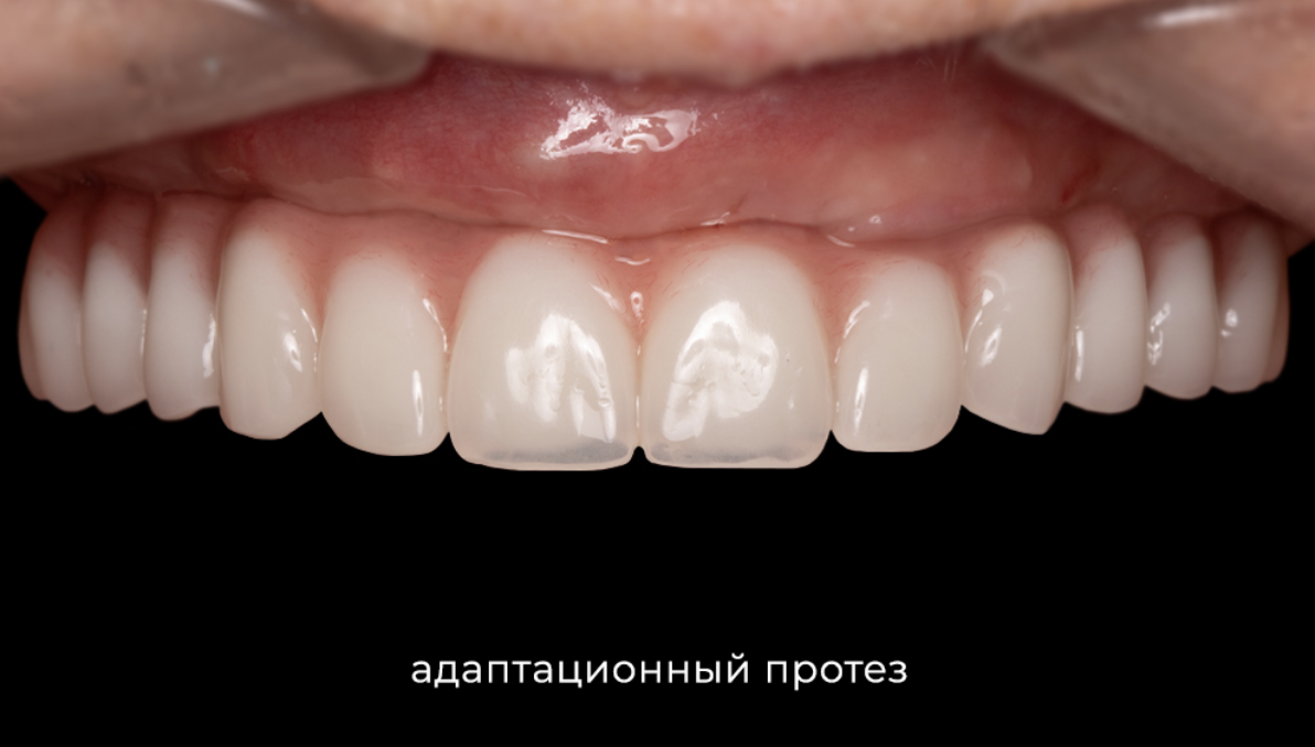 Адаптационный протез
