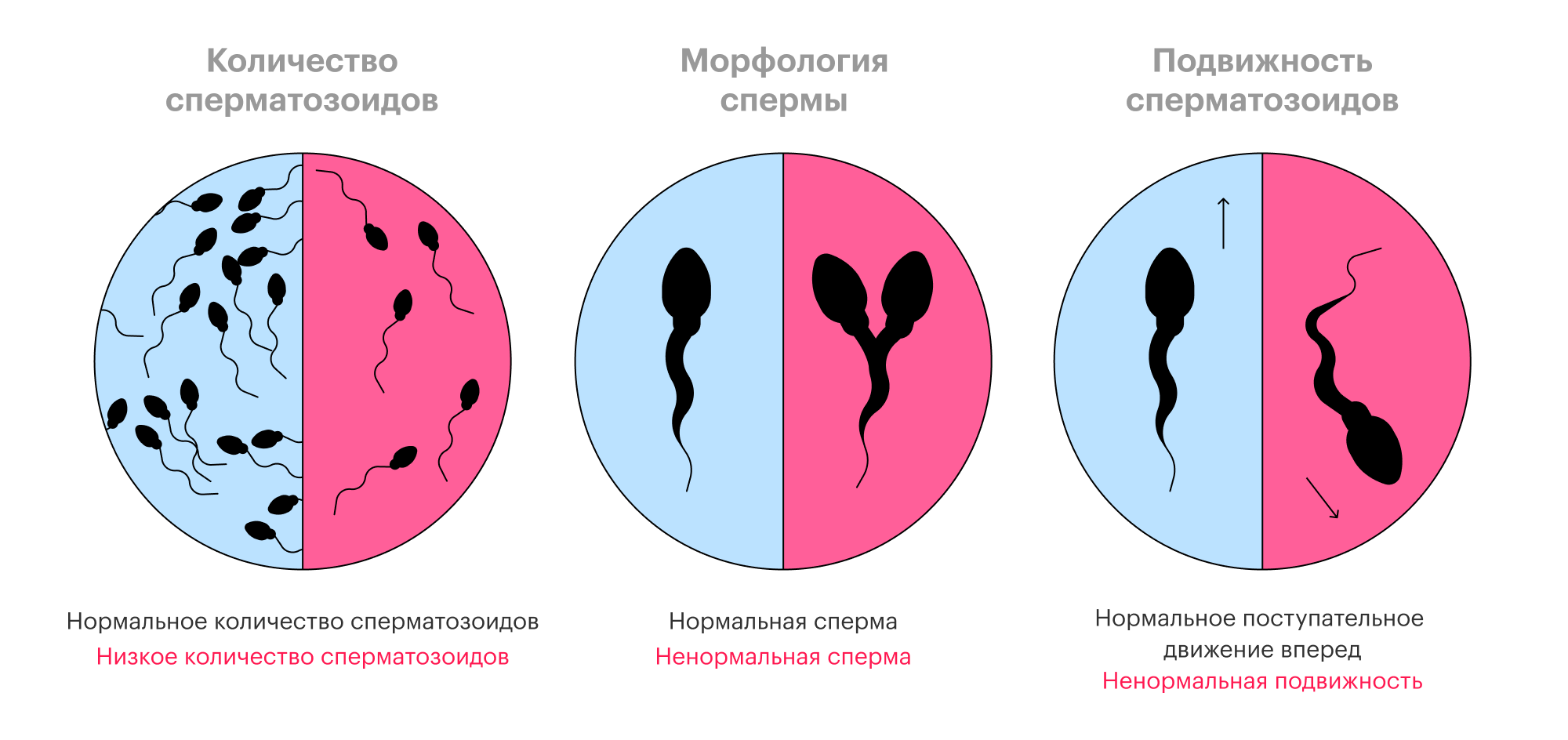 Три критерия здоровья сперматозоидов: количество, форма и подвижность. В синем поле — здоровая сперма, в красном — не очень