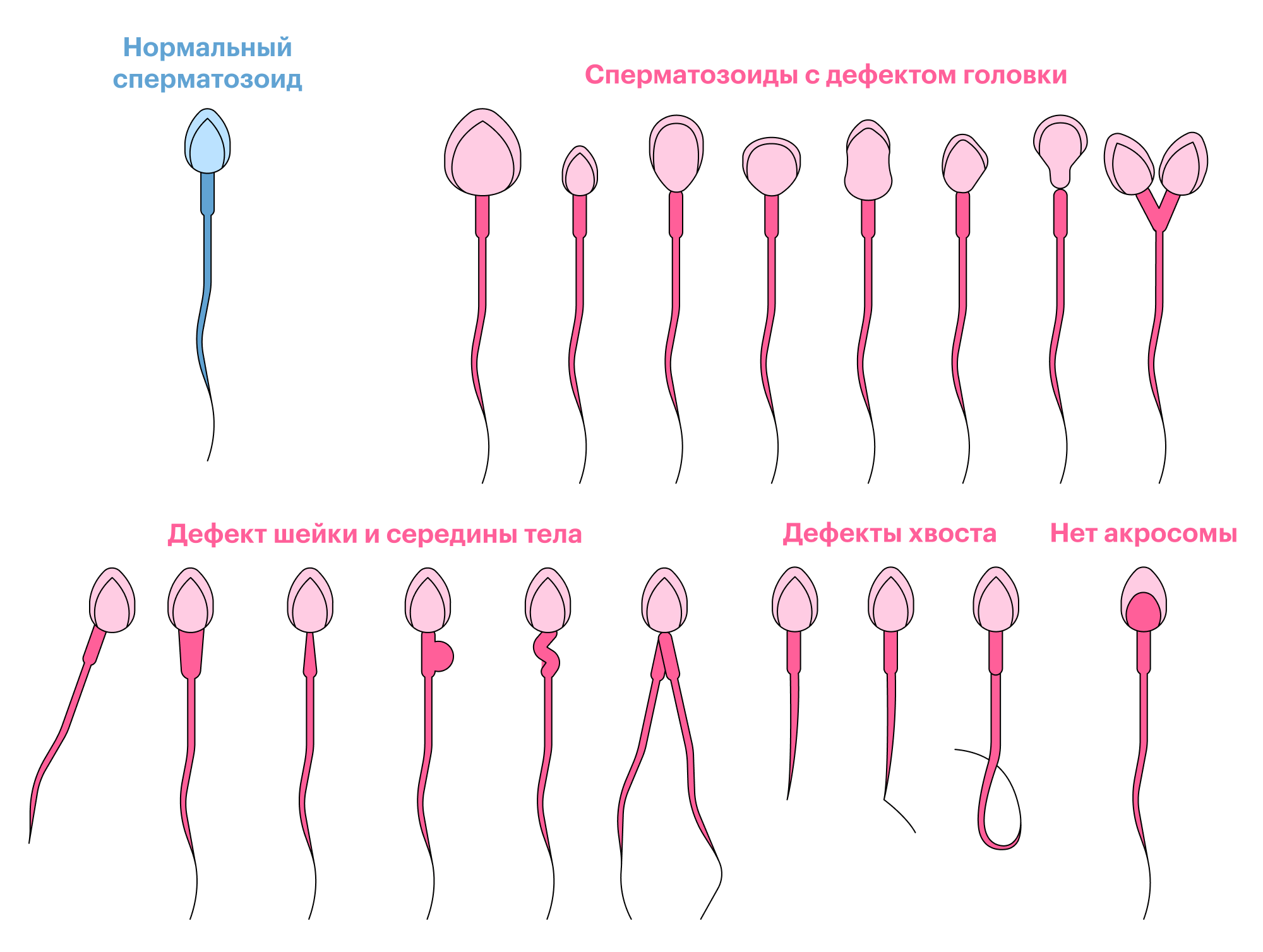 Анализ эякулята (спермограмма)