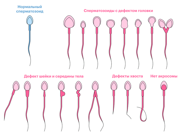 Что показывает спермограмма, как проводится исследование, когда его назначают?