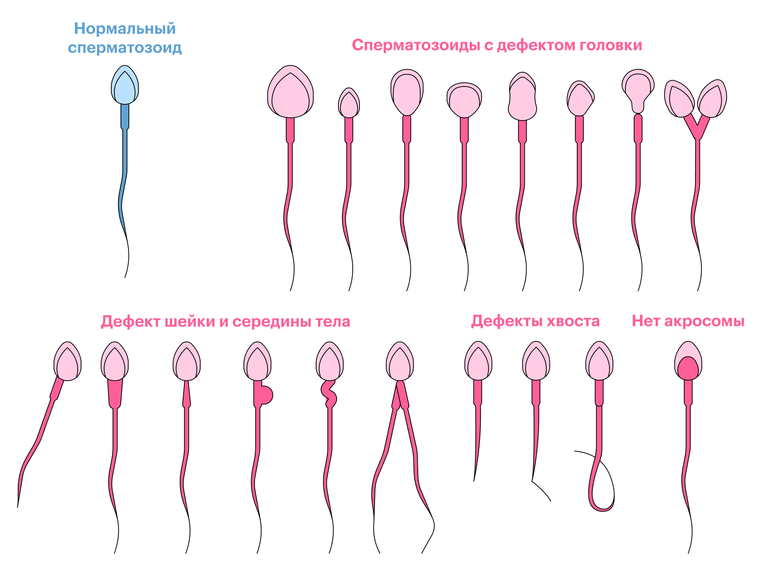 Как заморозка спермы влияет на ее качество?