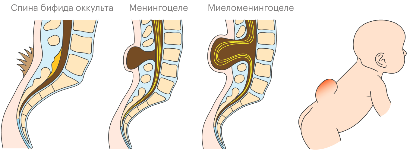 Так выглядят три самых распространенных формы спина бифида. Видно, как в зависимости от степени расщепления позвоночника спинной мозг и нервы развиваются внутри или вне тела — на наружной части спины