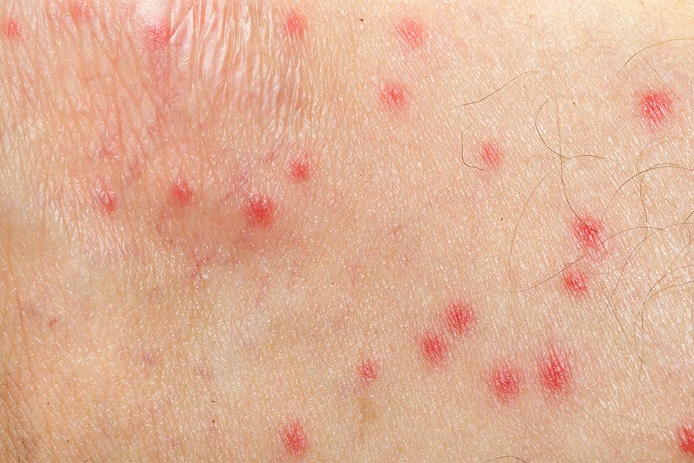 Почему чешется кожа после укуса комара?