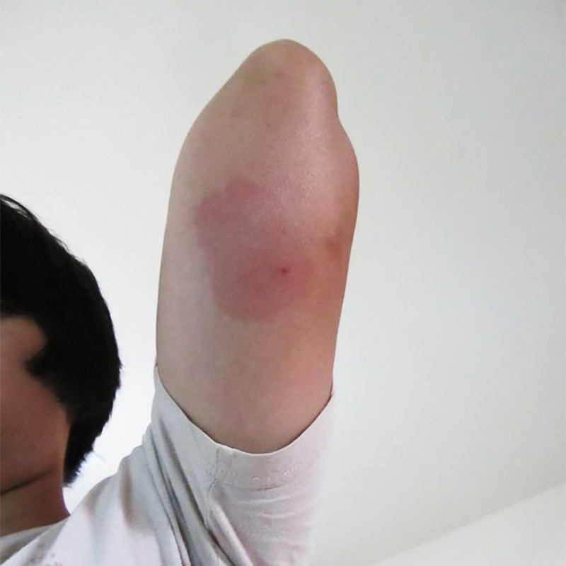 Синдром Скитера у подростка. Источник: skeetersyndrome.net