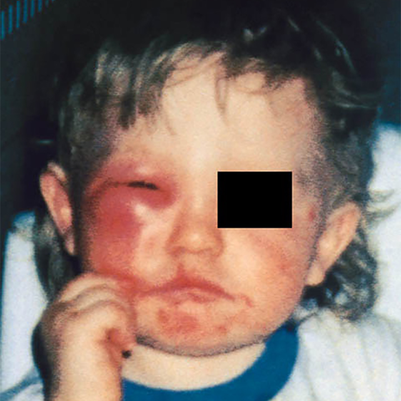 Синдром Скитера у ребенка. Источник: Журнал аллергологии и клинической иммунологии