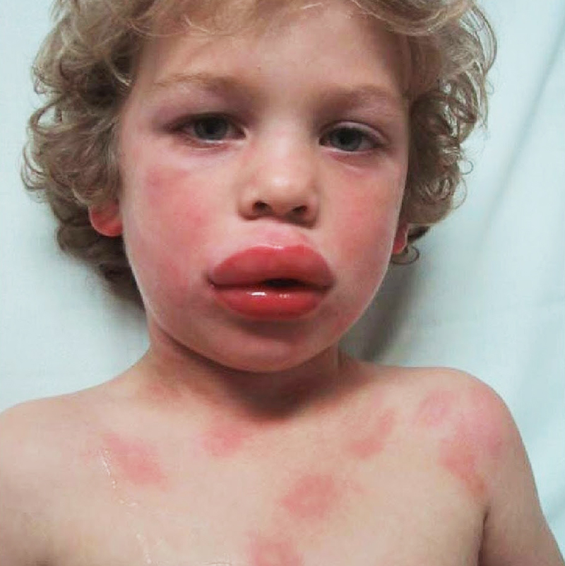 И у детей, и у взрослых при анафилаксии краснеют глаза, появляется сыпь