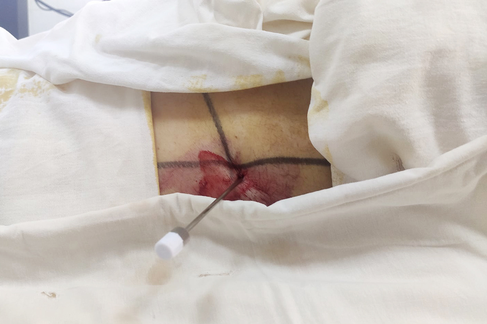 Доступ к почке во время нефролитотрипсии через кожу. Для удаления камня нужно только небольшое отверстие