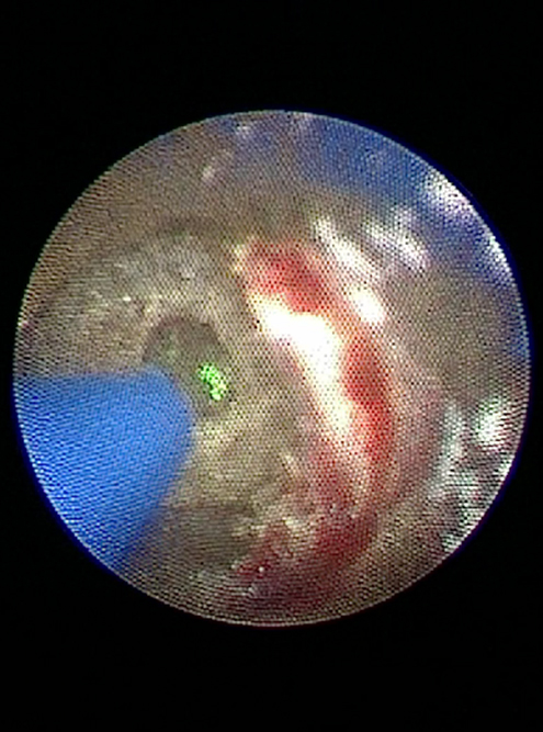 Так выглядит дробление камня в почке лазером