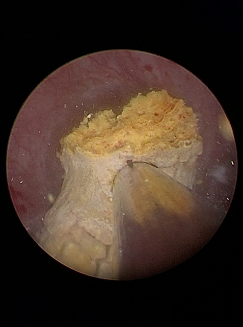 Так выглядит дробление крупного камня ультразвуком