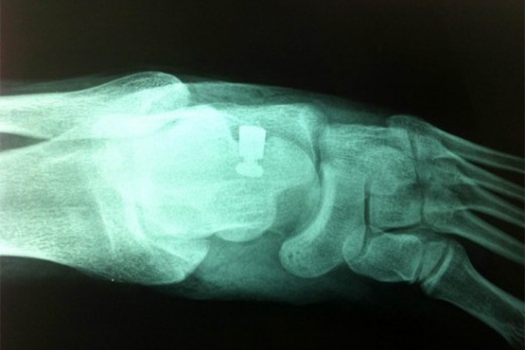 Так выглядит имплант в стопе на рентгенограмме. Фото героя интервью