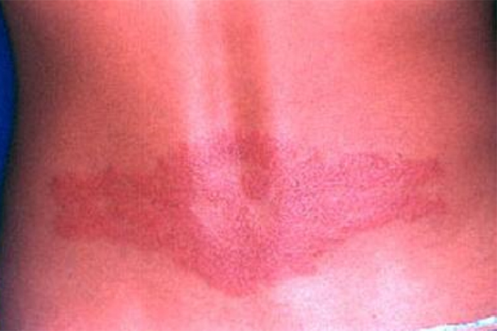Связанный с татуировкой контактный дерматит проявляется в виде красной зудящей сыпи. Источник: emedicine.medscape.com