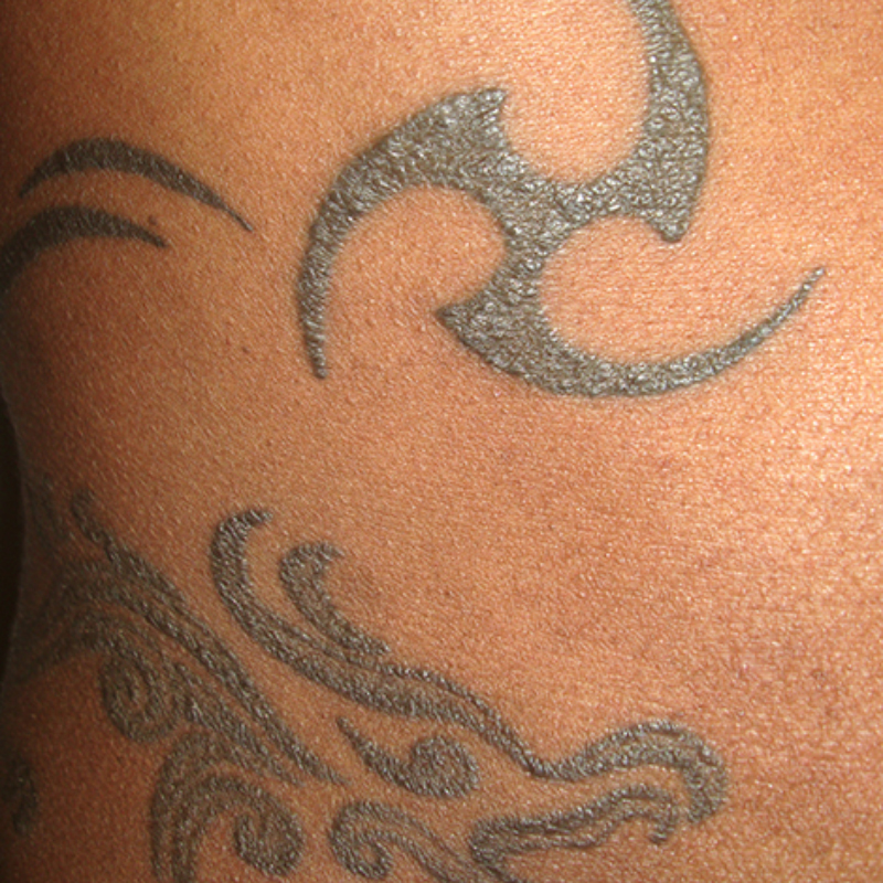 Саркоидозные узелки в области черной татуировки. Источник: uptodate.com